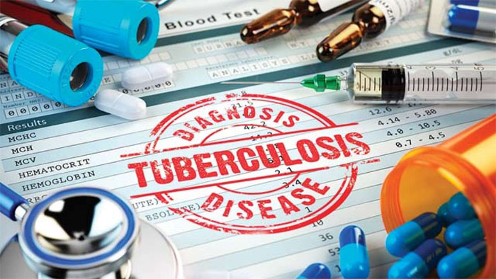 TB Elimination Possible in Next 24 Years – Lancet