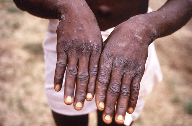 Ghana Records First Monkeypox Cases